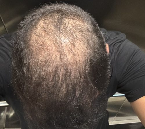 Paciente Fio Raiz antes do tratamento — coroa com rarefação